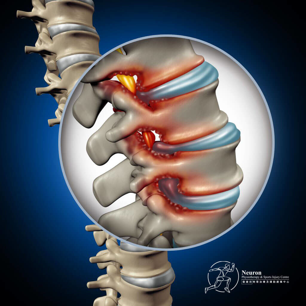 椎間盤突出, 椎間盤突出治療, Neuron 復健坊椎間盤突出物理治療 -構造