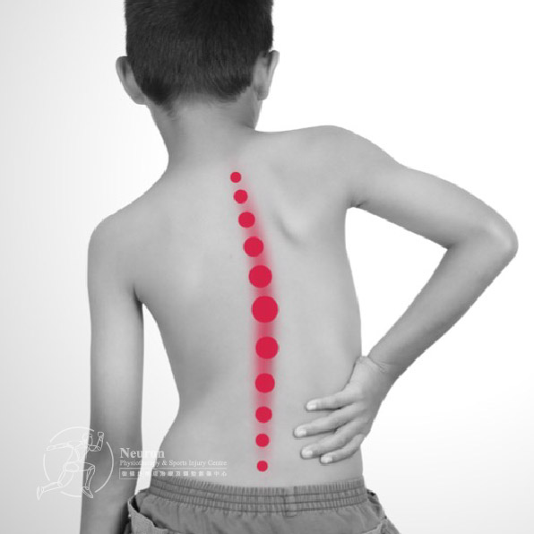 脊椎治療, 脊醫物理治療, Neuron 復健坊物理治療及運動創傷中心​ -脊柱側彎症
